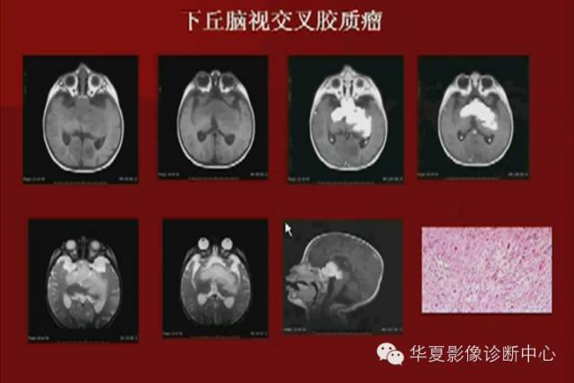 【PPT】下丘脑MR影像诊断