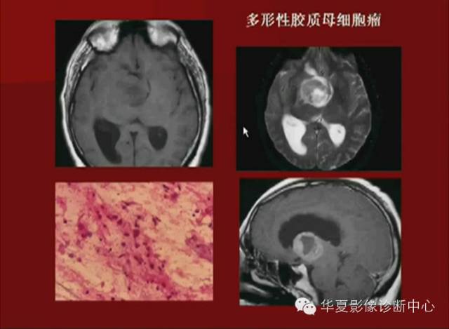 【PPT】下丘脑MR影像诊断