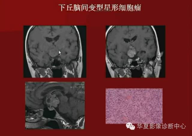 【PPT】下丘脑MR影像诊断