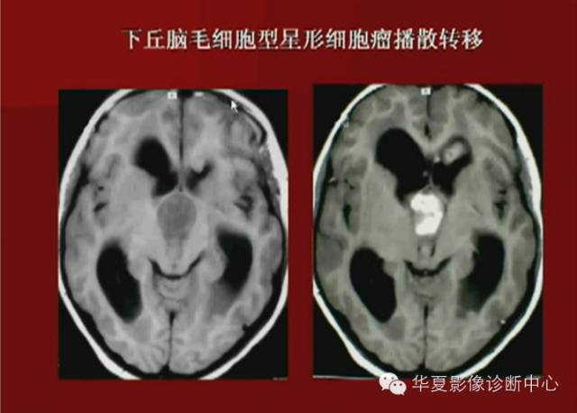 【PPT】下丘脑MR影像诊断