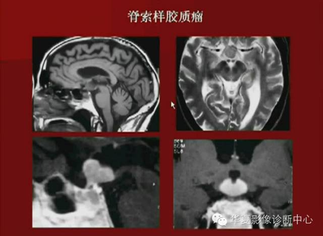 【PPT】下丘脑MR影像诊断