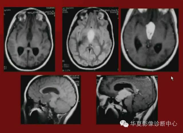【PPT】下丘脑MR影像诊断