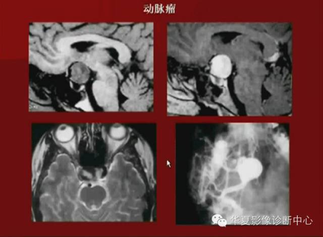 【PPT】下丘脑MR影像诊断