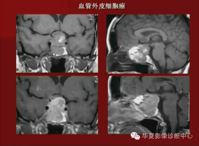 【PPT】下丘脑MR影像诊断