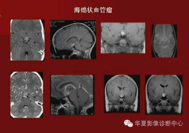 【PPT】下丘脑MR影像诊断