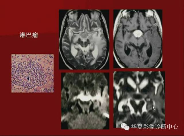 【PPT】下丘脑MR影像诊断