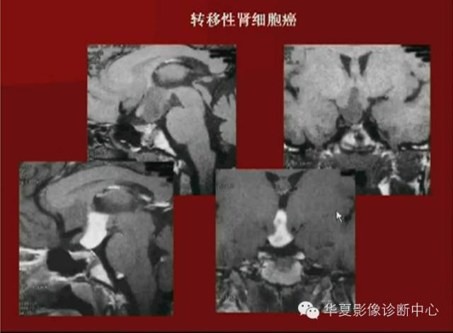 【PPT】下丘脑MR影像诊断