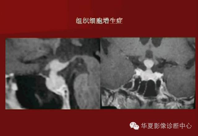 【PPT】下丘脑MR影像诊断