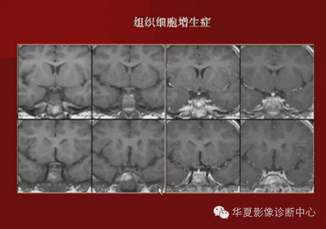 【PPT】下丘脑MR影像诊断