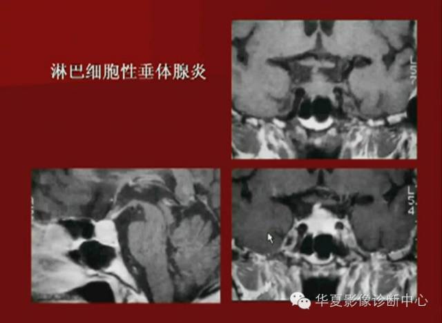 【PPT】下丘脑MR影像诊断