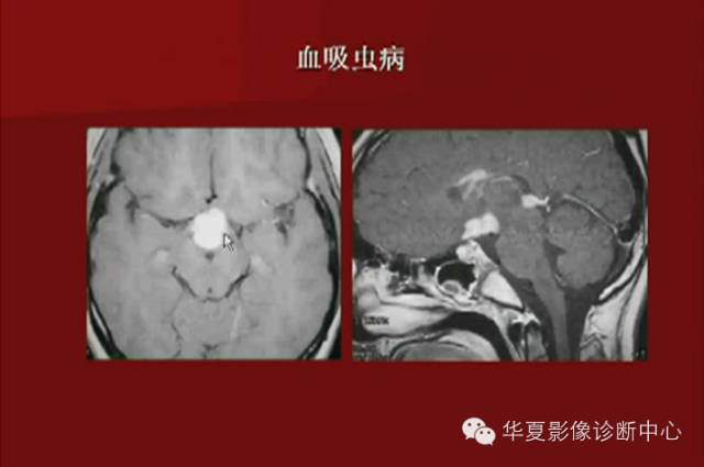 【PPT】下丘脑MR影像诊断