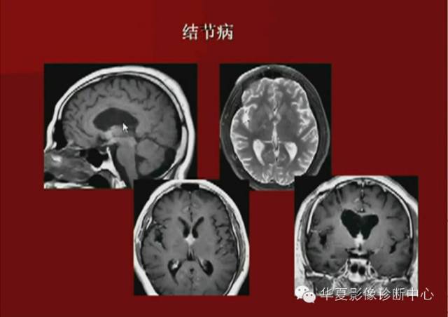 【PPT】下丘脑MR影像诊断