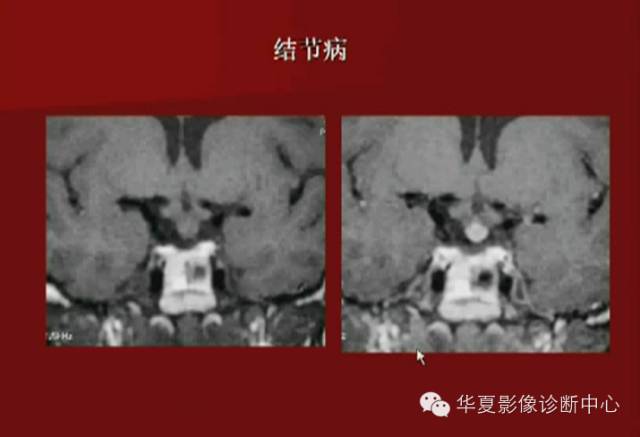 【PPT】下丘脑MR影像诊断
