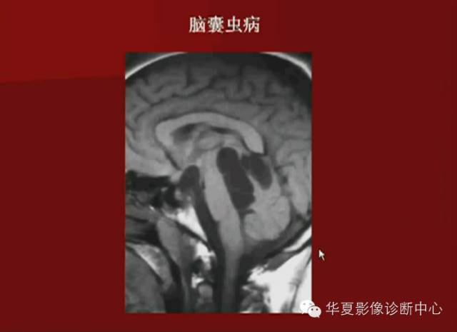 【PPT】下丘脑MR影像诊断