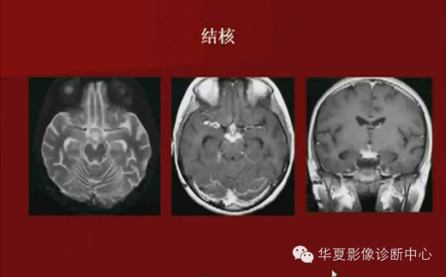【PPT】下丘脑MR影像诊断
