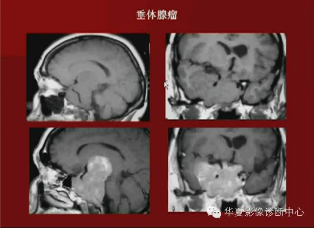 【PPT】下丘脑MR影像诊断