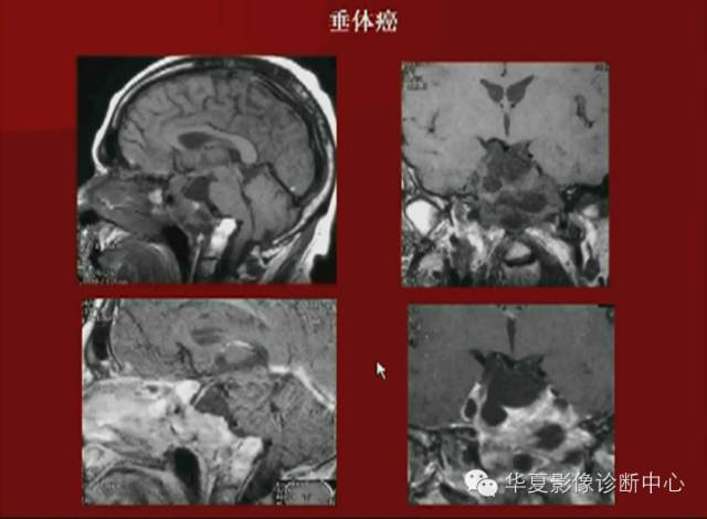 【PPT】下丘脑MR影像诊断