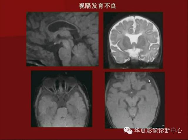 【PPT】下丘脑MR影像诊断
