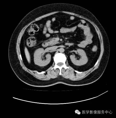 【病例】肾黏液样小管状和梭形细胞癌1例CT影像表现
