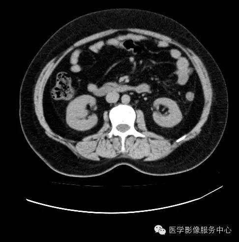【病例】肾黏液样小管状和梭形细胞癌1例CT影像表现 【病例】肾黏液样小管状和梭形细胞癌1例CT影像表现