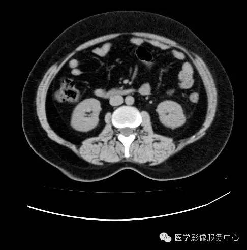 【病例】肾黏液样小管状和梭形细胞癌1例CT影像表现 【病例】肾黏液样小管状和梭形细胞癌1例CT影像表现