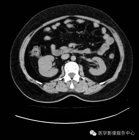 【病例】肾黏液样小管状和梭形细胞癌1例CT影像表现 【病例】肾黏液样小管状和梭形细胞癌1例CT影像表现