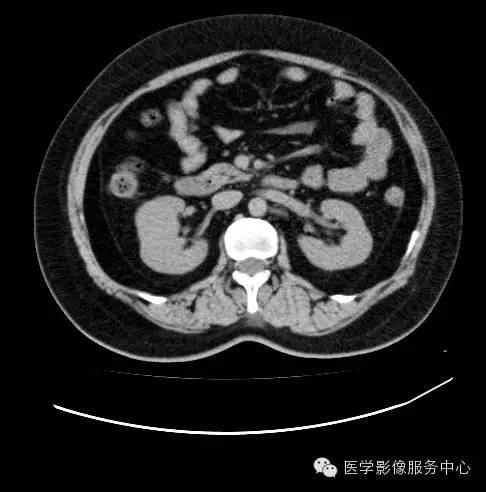 【病例】肾黏液样小管状和梭形细胞癌1例CT影像表现 【病例】肾黏液样小管状和梭形细胞癌1例CT影像表现