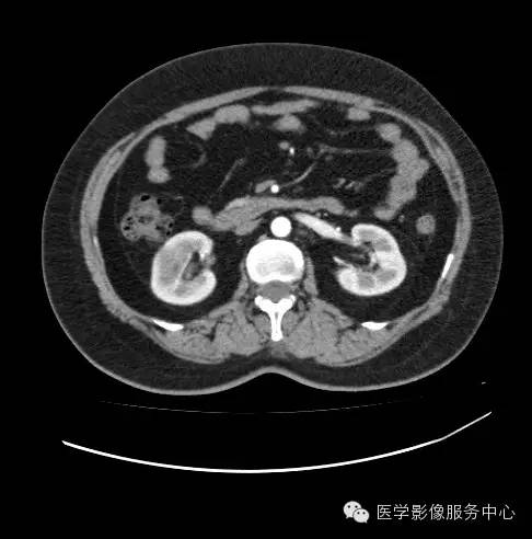 【病例】肾黏液样小管状和梭形细胞癌1例CT影像表现 【病例】肾黏液样小管状和梭形细胞癌1例CT影像表现