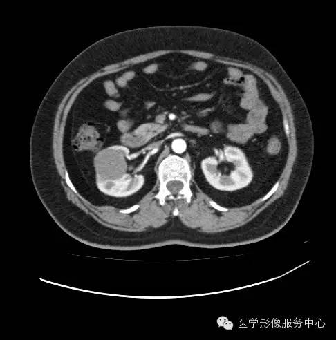 【病例】肾黏液样小管状和梭形细胞癌1例CT影像表现 【病例】肾黏液样小管状和梭形细胞癌1例CT影像表现