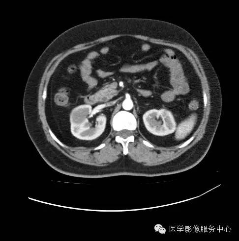 【病例】肾黏液样小管状和梭形细胞癌1例CT影像表现 【病例】肾黏液样小管状和梭形细胞癌1例CT影像表现