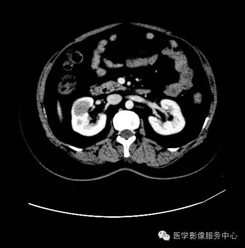 【病例】肾黏液样小管状和梭形细胞癌1例CT影像表现 【病例】肾黏液样小管状和梭形细胞癌1例CT影像表现