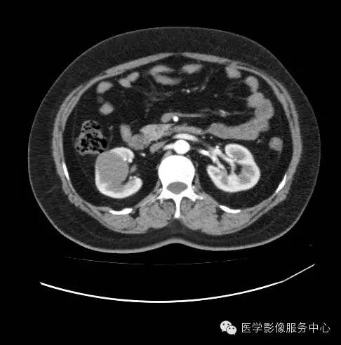 【病例】肾黏液样小管状和梭形细胞癌1例CT影像表现 【病例】肾黏液样小管状和梭形细胞癌1例CT影像表现
