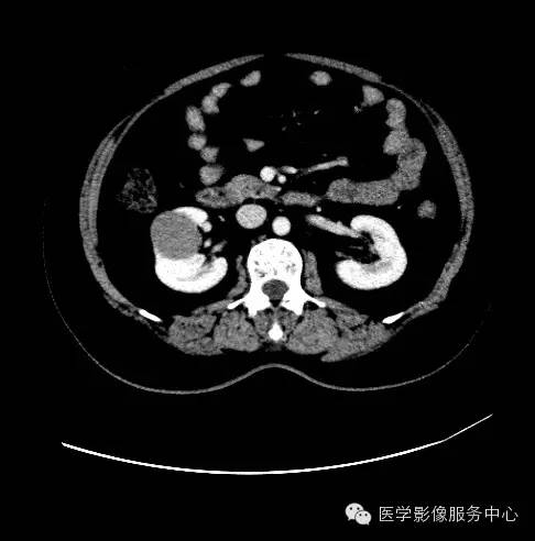 【病例】肾黏液样小管状和梭形细胞癌1例CT影像表现 【病例】肾黏液样小管状和梭形细胞癌1例CT影像表现
