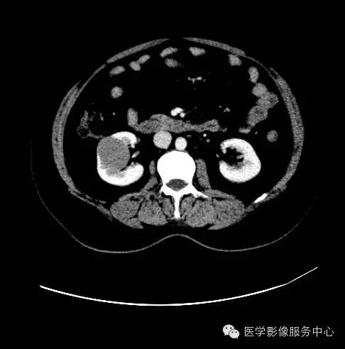 【病例】肾黏液样小管状和梭形细胞癌1例CT影像表现 【病例】肾黏液样小管状和梭形细胞癌1例CT影像表现