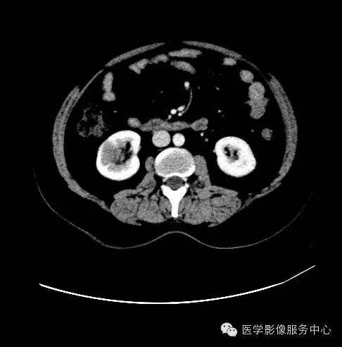 【病例】肾黏液样小管状和梭形细胞癌1例CT影像表现 【病例】肾黏液样小管状和梭形细胞癌1例CT影像表现