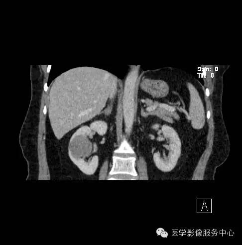 【病例】肾黏液样小管状和梭形细胞癌1例CT影像表现 【病例】肾黏液样小管状和梭形细胞癌1例CT影像表现