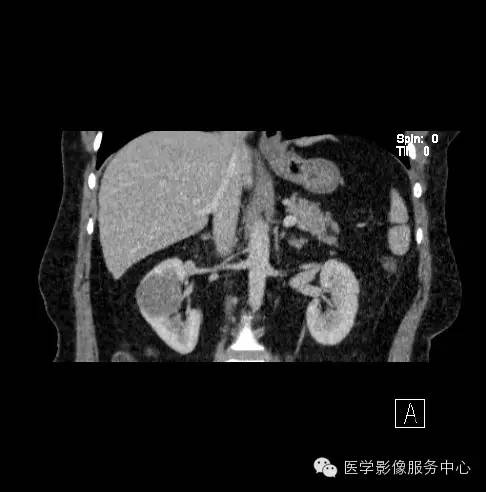 【病例】肾黏液样小管状和梭形细胞癌1例CT影像表现 【病例】肾黏液样小管状和梭形细胞癌1例CT影像表现