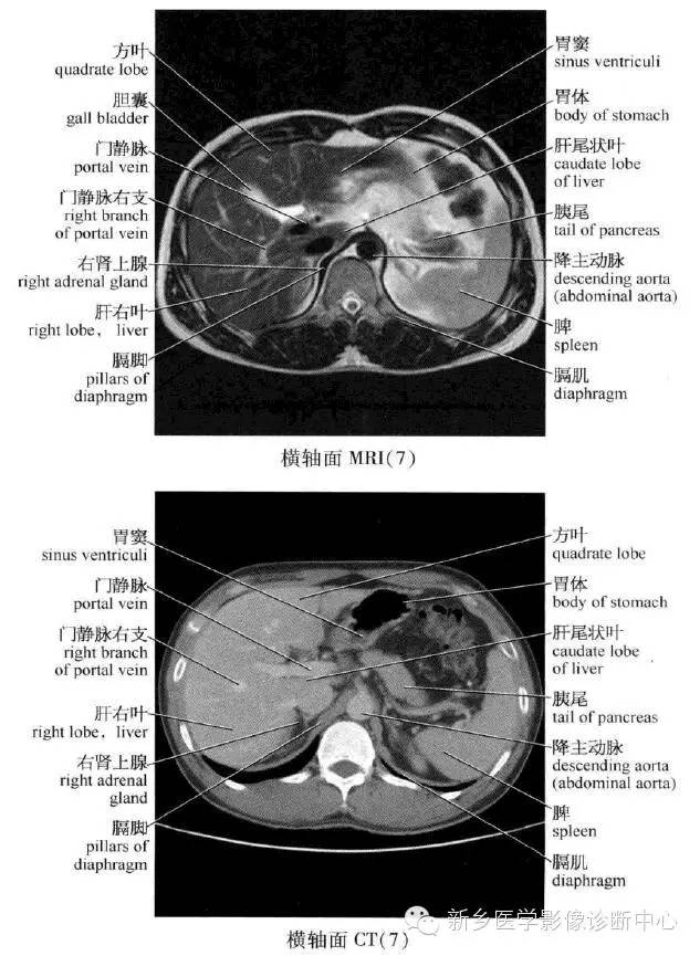 腹部横断位解剖+详细标注+肝脏分段