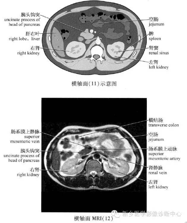 腹部横断位解剖+详细标注+肝脏分段