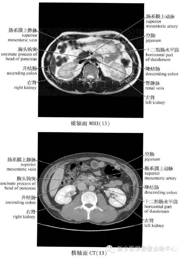 腹部横断位解剖+详细标注+肝脏分段