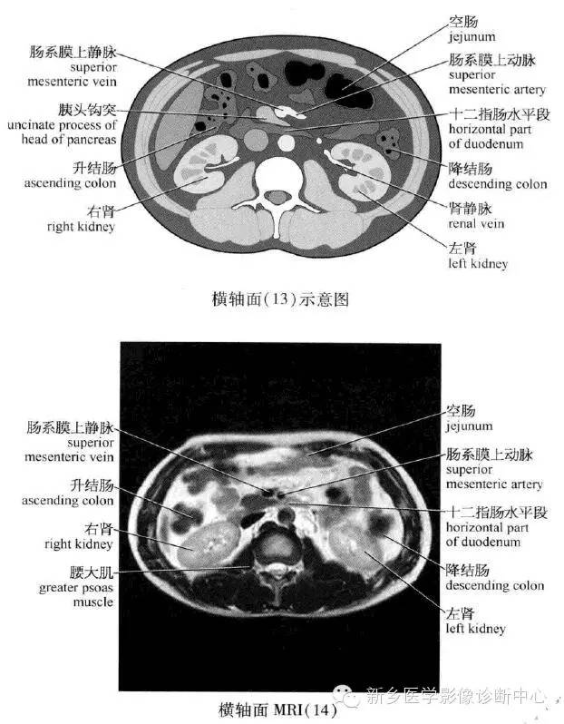 腹部横断位解剖+详细标注+肝脏分段