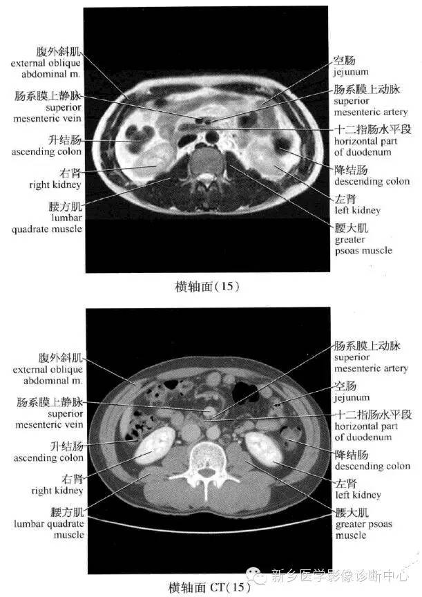 腹部横断位解剖+详细标注+肝脏分段
