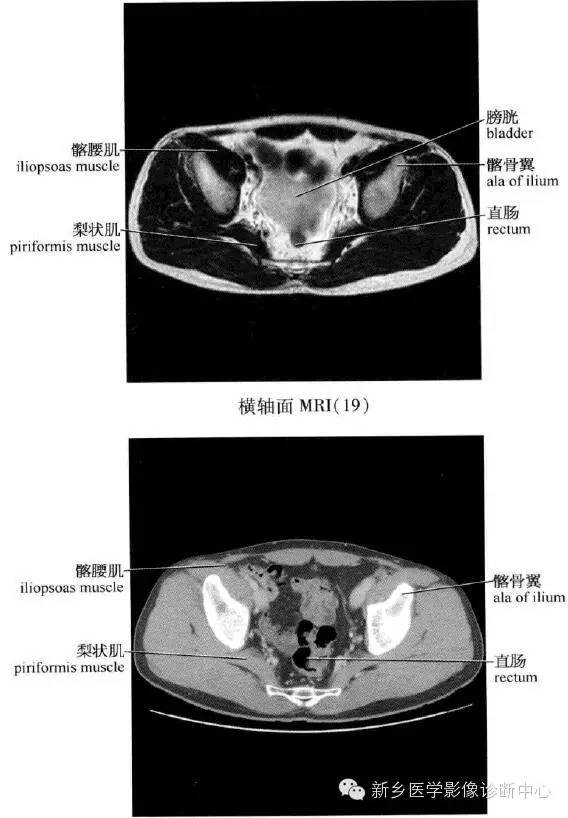 腹部横断位解剖+详细标注+肝脏分段