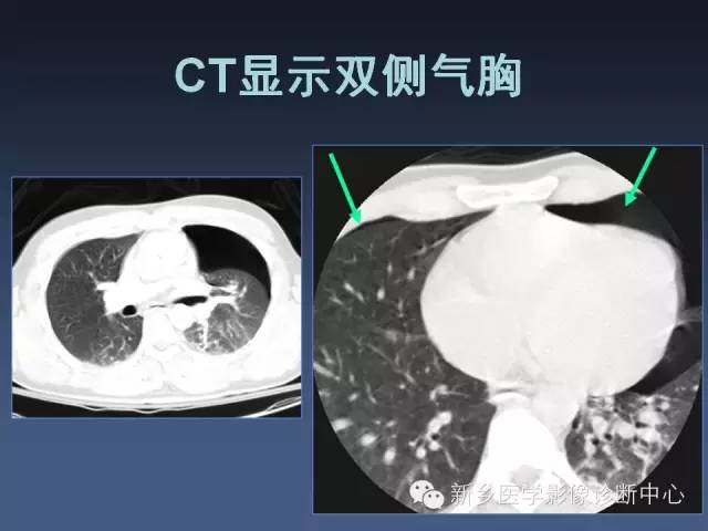 多层螺旋CT（MDCT）在胸部外伤诊断中的应用