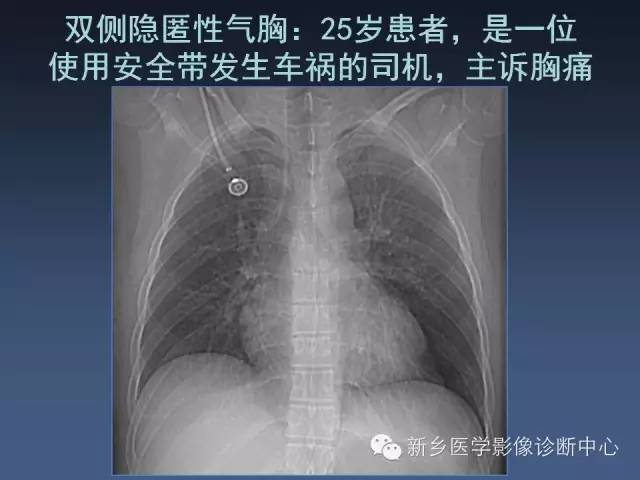多层螺旋CT（MDCT）在胸部外伤诊断中的应用
