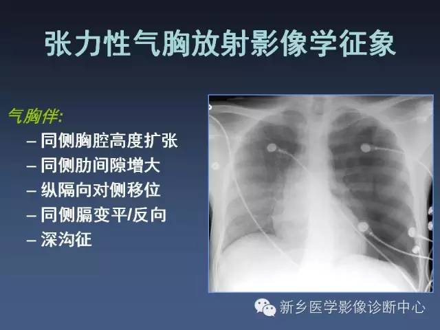 多层螺旋CT（MDCT）在胸部外伤诊断中的应用