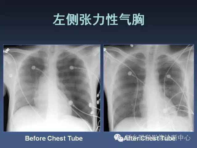 多层螺旋CT（MDCT）在胸部外伤诊断中的应用