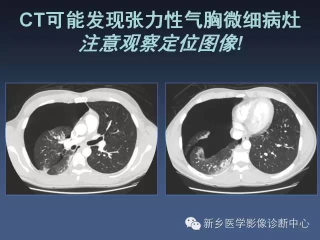 多层螺旋CT（MDCT）在胸部外伤诊断中的应用