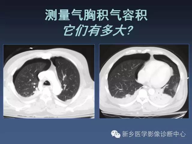 多层螺旋CT（MDCT）在胸部外伤诊断中的应用