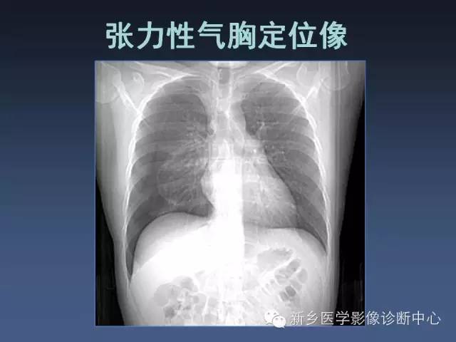 多层螺旋CT（MDCT）在胸部外伤诊断中的应用